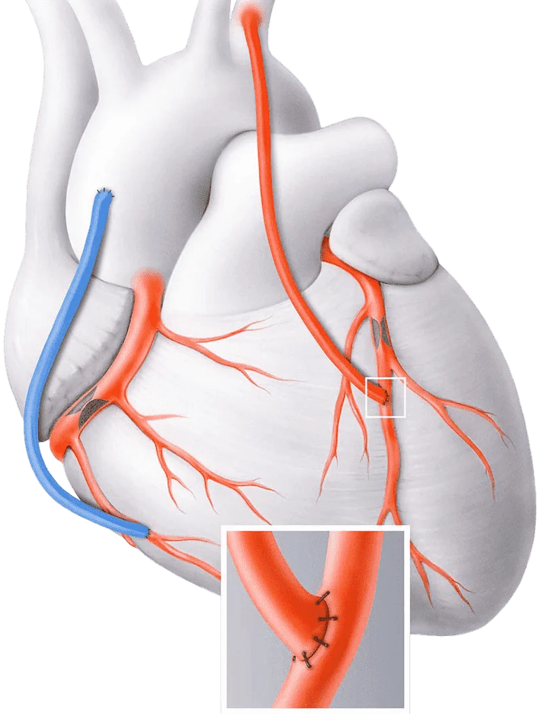 Chirurgie coronarienne